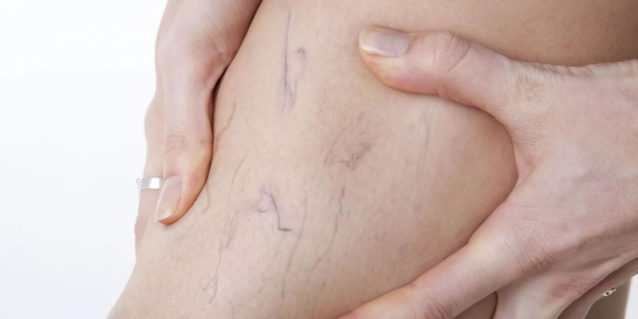 Before the use of varicon cream