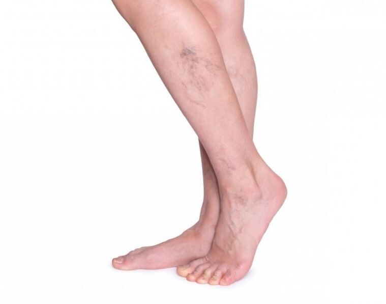 Varicosis vessels before treatment with zxcvbnmqw