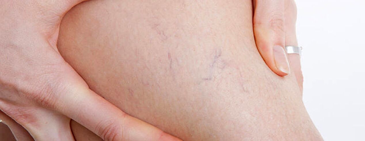 How are varicose veins