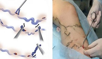 Flebectomy for varicose veins in the legs