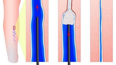 Sklerotherapy for varicose veins
