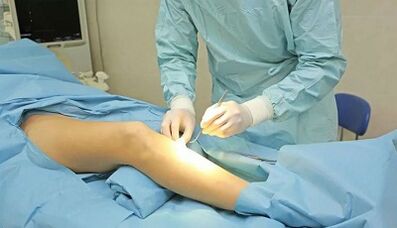 How is a transaction with varicose veins