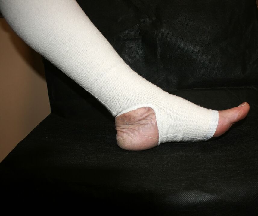 Compression knitting for varicose veins