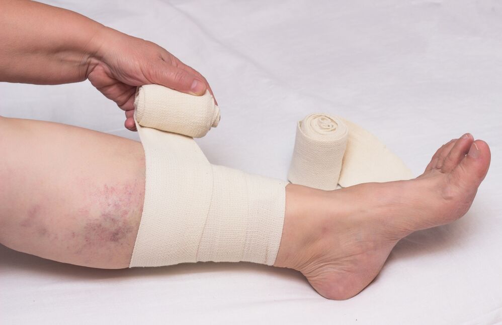 Treatment of bodies of varicose veins
